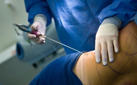 KFH yashyiriyeho Icyumweru kihariye abifuza kongeresha Ikibuno, Amabere no kugabanya Ibinure